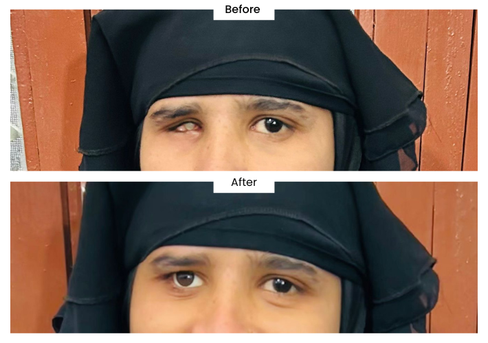 Ocular Prosthesis Clinic